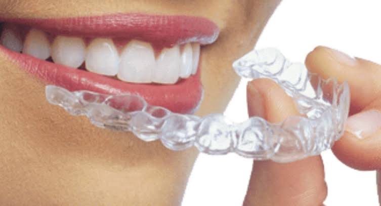 Aligners Treatment